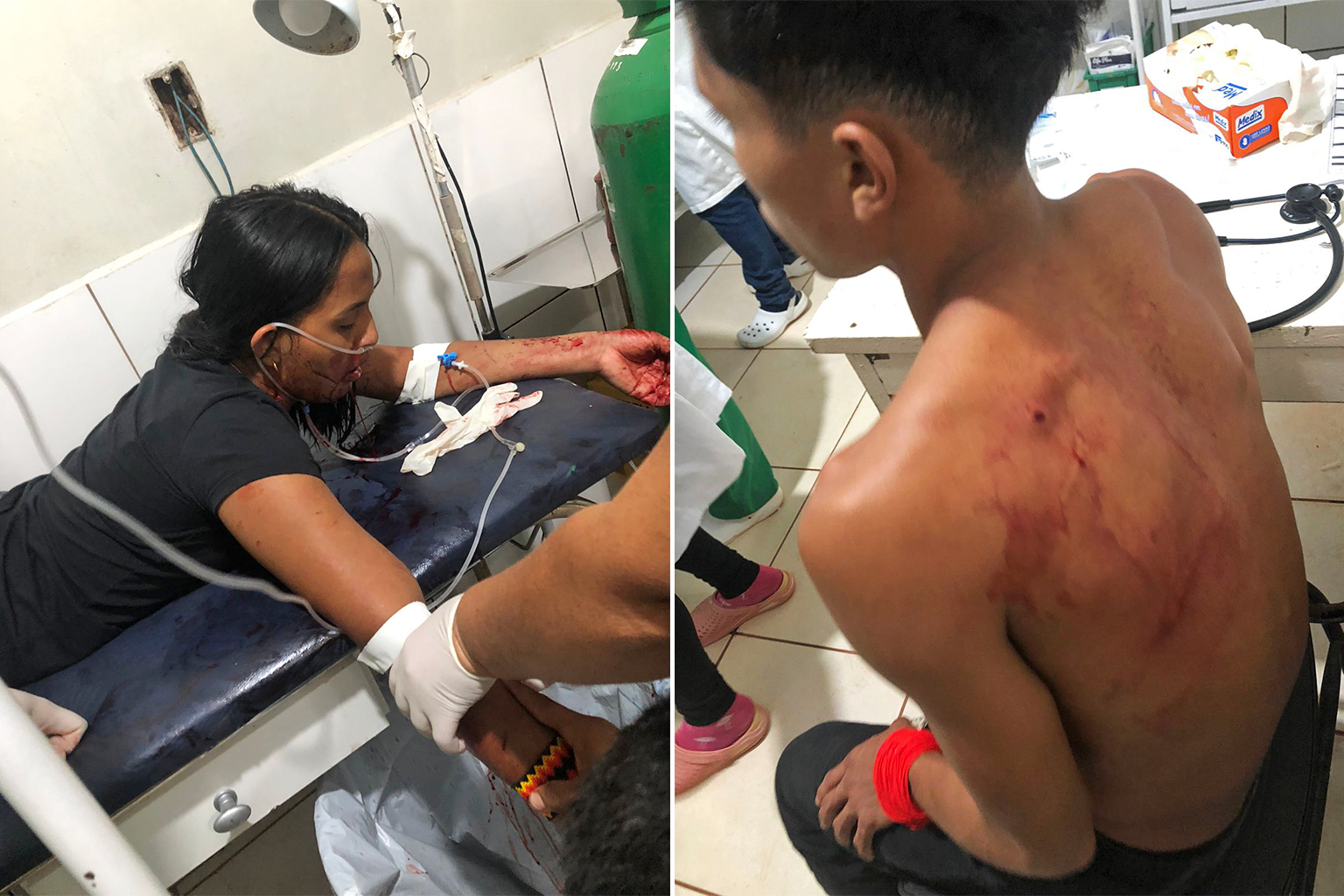 (Left) Dayane Tembé getting treated in the hospital after she was shot. (Right) Felipe Tembé also got shot. 